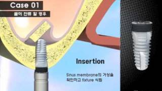 SinusT sinus lift technique for dental implants using DIOs specialist burrs and osteotome kit [upl. by Shutz]