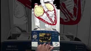 Atrial Fibrillation Cardioversion Video and Animation 🫀🔌 medical cardiology [upl. by Menis346]