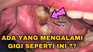 SISA AKAR GIGI  Dokter Gigi Tri Putra [upl. by Otipaga]