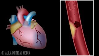 Myocardial Infarction and Coronary Angioplasty Treatment Animation [upl. by Eimot]