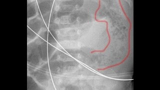 Enterocolite necrotizante com pneumatose intestinal [upl. by Marlon]