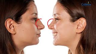 Rhinoplasty is typically done to reshape the nose but it can also help treat snoring [upl. by Maryjo]