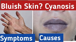 What is Cyanosis bluish skin cyanosis symptoms what is the cause of cyanosis [upl. by Ssecnirp]