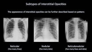 How to Interpret a Chest XRay Lesson 7  Diffuse Lung Processes [upl. by Lamiv928]