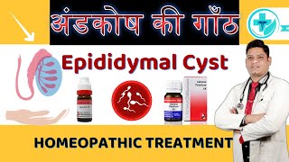 Epididymal Cyst Homeopathic Medicine  Best Treatment for Epididymitis  Dr Sunil Patidar [upl. by Cybill]