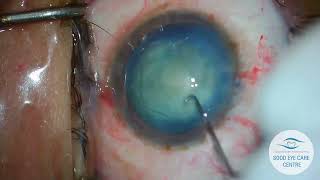 Phaco in mature Cataract [upl. by Franciskus]