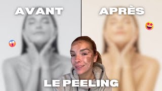 PEELING  Les avant  après [upl. by Juback]