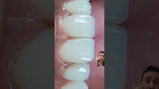 FECHAMENTO DE ESPAÇOS  DIASTEMAS COM RESINAS dentista facetadental odontologia [upl. by Jobie]