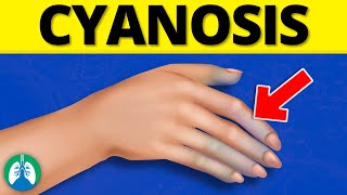 What is Cyanosis EXPLAINED [upl. by Uhile466]