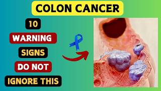 Warning Don’t Ignore These 10 Early Signs of Colon Cancer [upl. by Fabrianne]