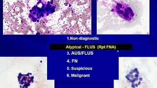 Thyroid Cytology I Approach [upl. by Dania]