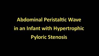 Peristaltic Waves in Hypertrophic Pyloric Stenosis [upl. by Eiramacissej682]