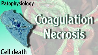 Pathophysiology  Coagulation Necrosis Hani Laith شرح [upl. by Ahsaekal]