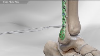 Distal Fibular Plate [upl. by Stinky]