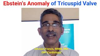 Ebsteins Anomaly of Tricuspid Valve [upl. by Culver]