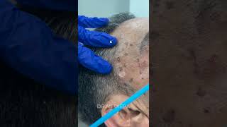 Say goodbye to the unwanted moles skin tags or any lesions  Dr MediSpa [upl. by Johannessen]