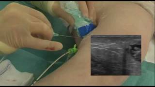 Patient Video of Radiofrequency ablation of Varicose Veins with the RFiTT system [upl. by Ahsilrak]