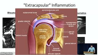 Polymyalgia Rheumatica What has changed since 1957 [upl. by Rihsab]