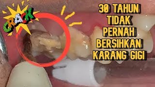 Belum Pernah Membersihkan Karang Gigi  Calculus  Dokter Gigi Tri Putra [upl. by Akceber76]