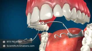 Jaw Surgery for Teeth Alignment  Fixing Jaw Braces [upl. by Annoyek]