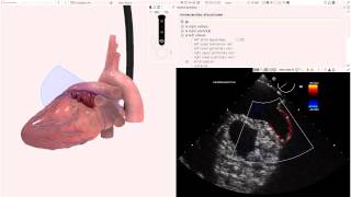 HeartWorks Unilobed Left Atrial Appendage [upl. by Nyliak]