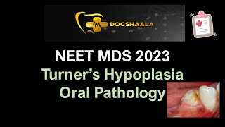 Turners Hypoplasia  Oral Pathology  NEET MDS Recall 2023 [upl. by Avitzur]