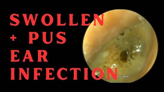 SWOLLEN amp PUS FILLED EAR CANAL DUE TO INFECTION 4K 60FPS [upl. by Sabah]