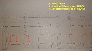 ECG WITH CONDUCTION PROBLEMS WHAT WILL YOU DO [upl. by Lehcer717]