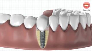 Vidéo de démonstration pour une pose dimplant dentaire [upl. by Yslek]