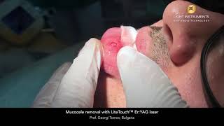 Mucocele removal with LiteTouch™ ErYAG laser [upl. by Odranar612]