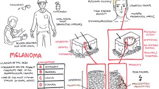 Melanoma  Overview signs and symptoms pathology risk factors treatment [upl. by Dede]