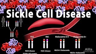 Sickle Cell Disease Animation [upl. by Tiler28]