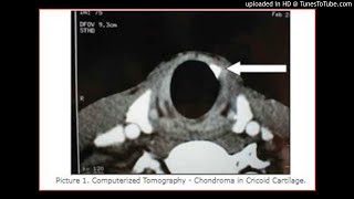 Chondroma of The Cricoid CartilageThe larynx cartilaginous tumors [upl. by Bjorn]