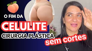 Medicina Estética PMMA Correção da Celulite e Flacidez com Dr Tiago Bacha [upl. by Alena]