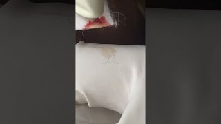 Big Cystic Acne Blackheads Extraction Blackheads amp Milia Whiteheads Removal Pimple Popping shorts [upl. by Kelam]