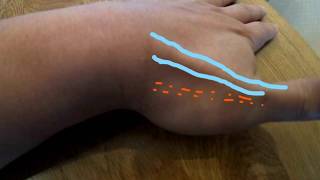 Howto Ultrasonography  De Quervain disease [upl. by Tsepmet]