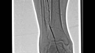 Angiography  Lower Extremities RSMDSA [upl. by Kristel]