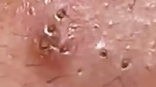 Extraction profonde des points noirs Acné kystique et popping 4 [upl. by Oidgime]