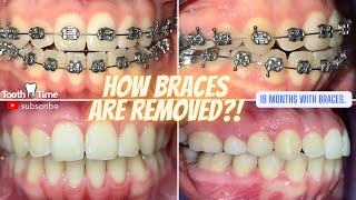 How Braces Are Removed  Open Bite Fixed 18 months Tooth Time Family Dentistry New Braunfels Texas [upl. by Ongineb335]