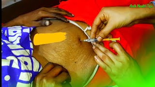 How to inject Filgrastim PFS 30 MIU05 ml Filastin 30  Subcutaneously Navel Injection Push Video [upl. by Socem]