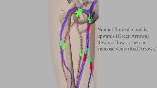 Radiofrequency Ablation  Treatment of Varicose Veins [upl. by Adlesirhc]