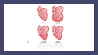 شرح محاضرة Cardiomyopathies and myocarditis  Part 1 [upl. by Oicanata]