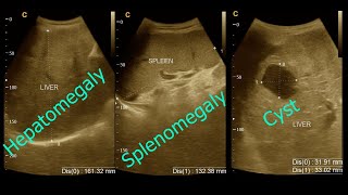 Hepatomegaly  Liver cyst  Part  1  Splenomegaly  Amader hospital  Ultrasonography report [upl. by Cordle475]