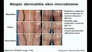 Eczema Immunity and the Skin Microbiome  Heidi Kong [upl. by Atinhoj832]