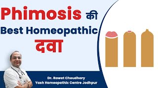 Best Homeopathic Medicine for Phimosis  Phimosis का बिना ऑपरेशन के इलाज Best Treatment of Phimosis [upl. by Ahseena]