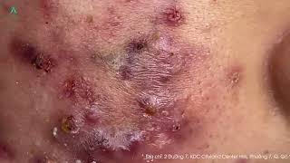 Big Cystic Acne Blackheads Extraction Blackheads amp Milia Whiteheads Removal Pimple Popping [upl. by Paz]