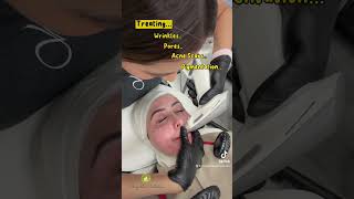 Sublative Radiofrequency Skin tightening [upl. by Sternick896]