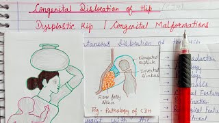 Congenital dislocation of hip part1Dysplastic hip Congenital malformation [upl. by Eki]