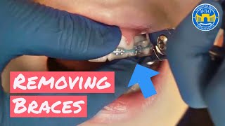 Process of Removing Braces [upl. by Darahs]