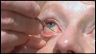 Oculoplastics basic exam Lacrimal system examination [upl. by Brina]